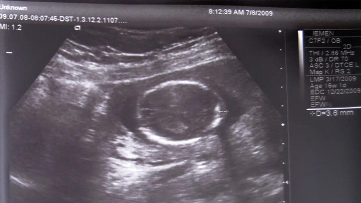 Este incredibil ce i-au gasit unei femei de 82 de ani in burta! Medici au ramas fara cuvinte