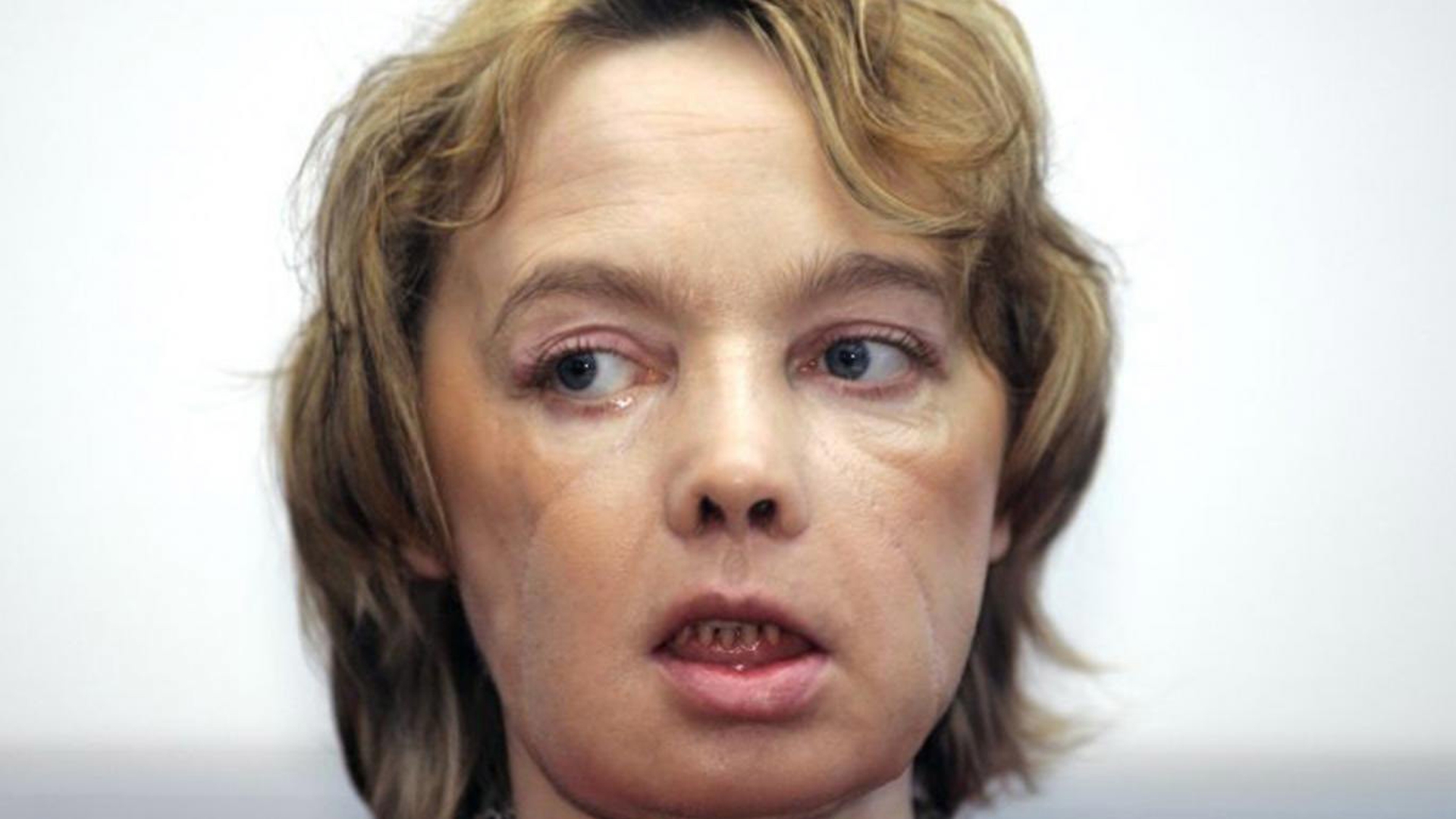Medicii i-au dat o faţă nouă, dar nu au mai putut să o salveze! A murit prima femeie supusă unui transplant de faţă!