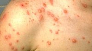 O fata de 11 ani bolnava de varicela a murit, dupa ce bunica ei a dat-o cu o solutie toxica crezand ca are raie