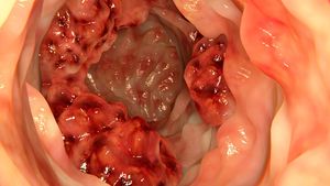 Primul semn al cancerului la colon! Fii foarte atent și nu neglija...