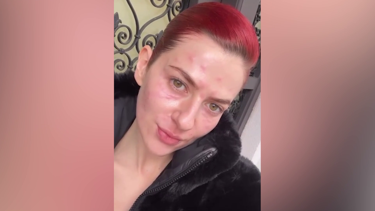 Lidia Buble și-a speriat fanii! A apărut cu fața inflamată și amorțită: „Nu arată rău. Acum e cel mai umflat”