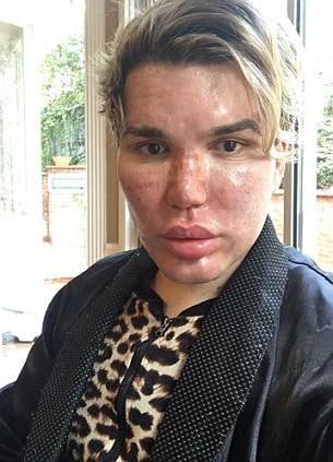 „Păpuşa umană“ KEN şi-a făcut o nouă operaţie estetică şi a mărturisit: „Bucăţi mari de piele au început să mi se desprindă de pe faţă“