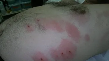 INVAZIA CAPUSELOR! Un iesean a fost muscat de 12 capuse in cateva minute in timp ce se relaxa in iarba