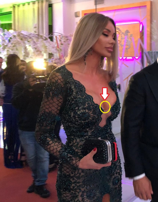 Bianca Drăgușanu, cu o vânătaie imensă pe bust. A fost lovită în sâni?!