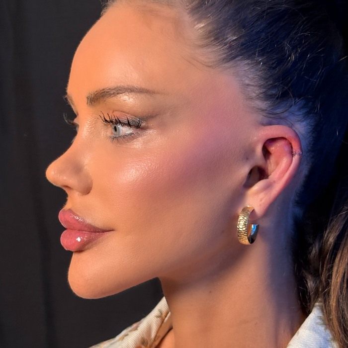 Cum arată Bianca Drăgușanu după ce și-a operat urechile. Cum a decurs intervenția de otoplastie