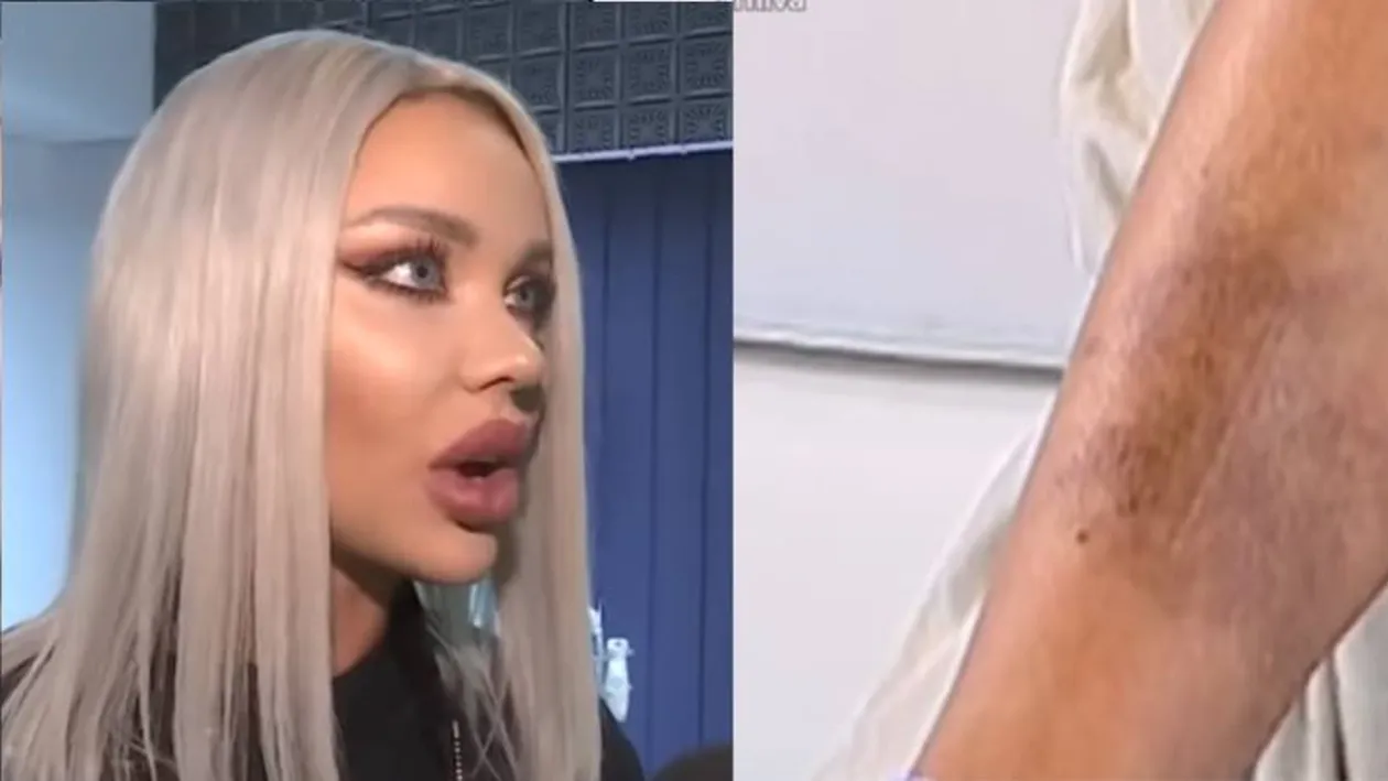 Bianca Drăgușanu, din nou învinețită. Ce spune despre Alex Bodi
