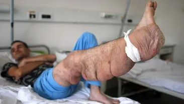 FOTO SOCANT! Uite cum arata barbatul cu picior de elefant