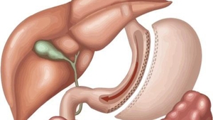Vedete care şi-au micşorat stomacul. Viaţa li s-a schimbat total după operaţie