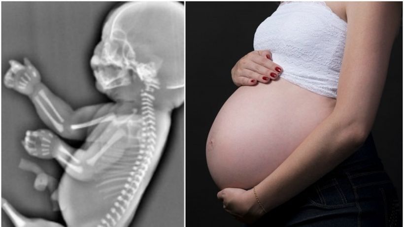 O tânară a aflat la ecografie că bebeluşul ei are o coadă în loc de picioare! Ce decizie a luat