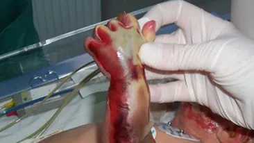 Un bebelus de 11 luni a fost transportat la spital cu arsuri grave pe corp!