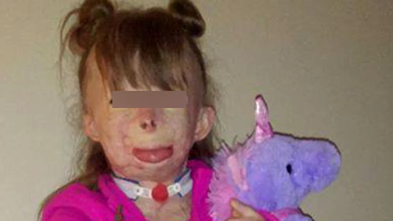 O fetita de 8 ani a fost mutilata de flacari! Cazul sau a impresionat o celebra vedeta