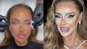 Bianca Drăgușanu și-a micșorat urechiile! Nu renunță la operații nici în ruptul capului: „Am făcut-o și pe asta”