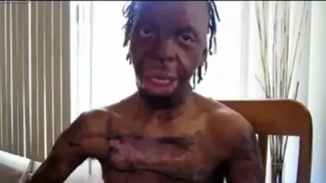 Un artist a fost ars de viu, dar a scăpat cu viaţă! Felul în care arată acum te va face să ai coşmaruri! Vezi un VIDEO INCREDIBIL