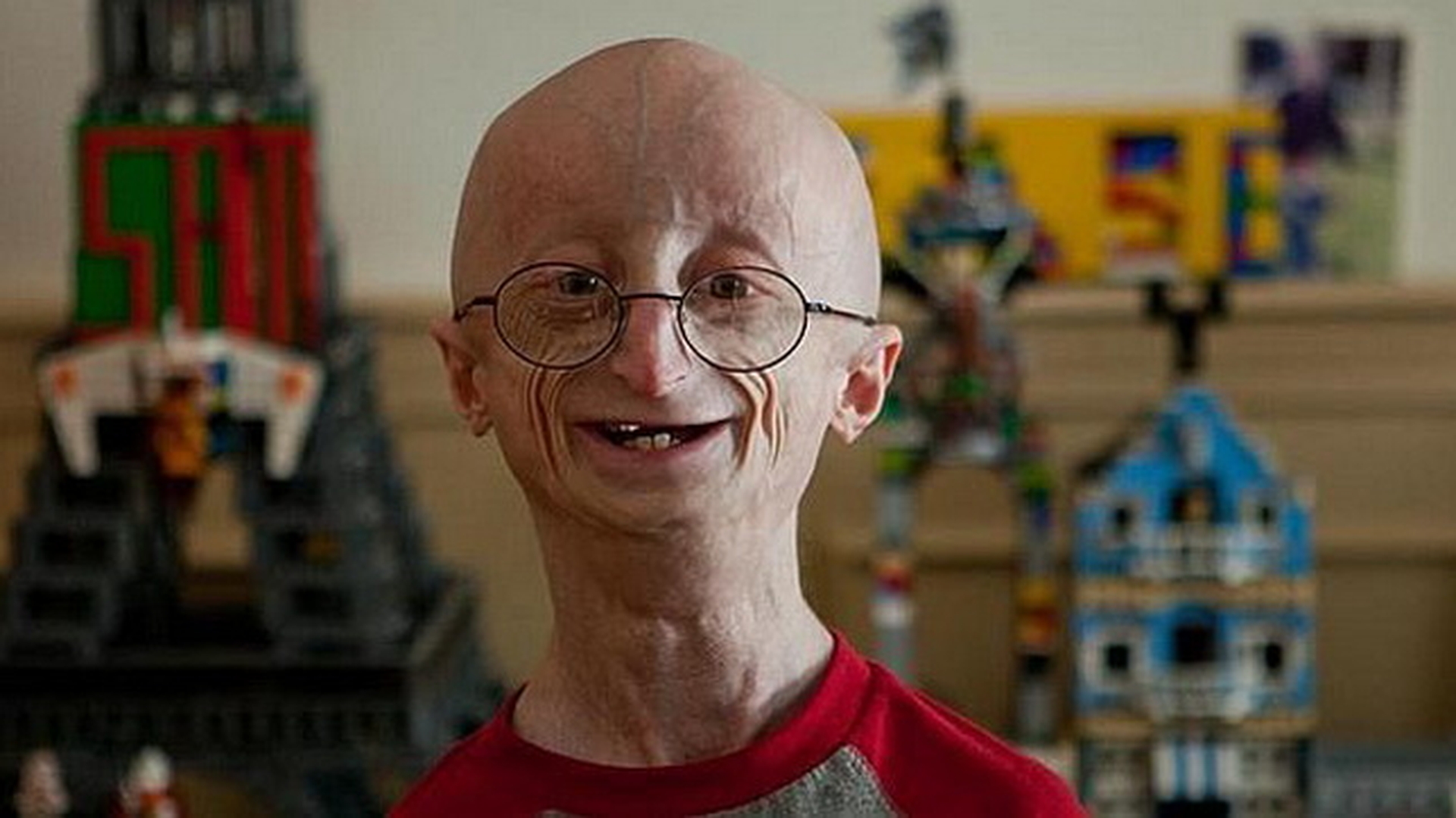 A murit tanarul care suferea de o boala cumplita! Sam Berns avea doar 17 ani, dar arata ca un BATRAN!