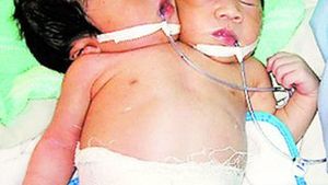 Caz incredibil in Vietnam! Fetita cu doua capete