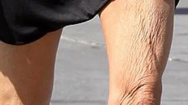 Imagini horror! Un fost model a speriat telespectatorii cu picioarele ei! Poarta rochii scurte, desi ii atarna pielea ingrozitor!