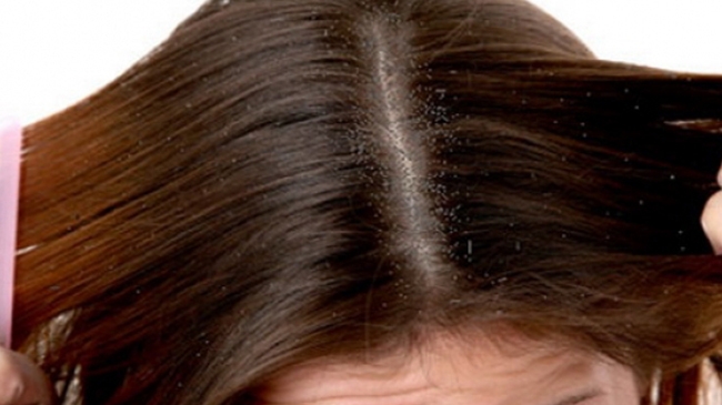 Scapă de mătreaţă cu soluţii naturale şi la îndemâna oricui! Remediile care nu dau greş!