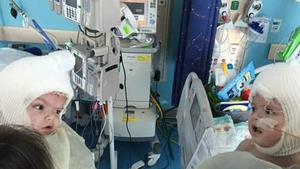Emoţionant! Doi gemeni se privesc în ochi, după ce s-au născut lipiţi în zona capului