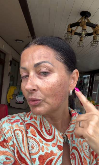Gabriela Cristea și-a liniștit fanii după ce a apărut plină de pete pe ten. La ce procedură a apelat vedeta