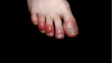 Medicii au vorbit despre ”degetele COVID-19”, simptomul asociat infectării cu temutul virus: ”Pare să fie un efect secundar....”