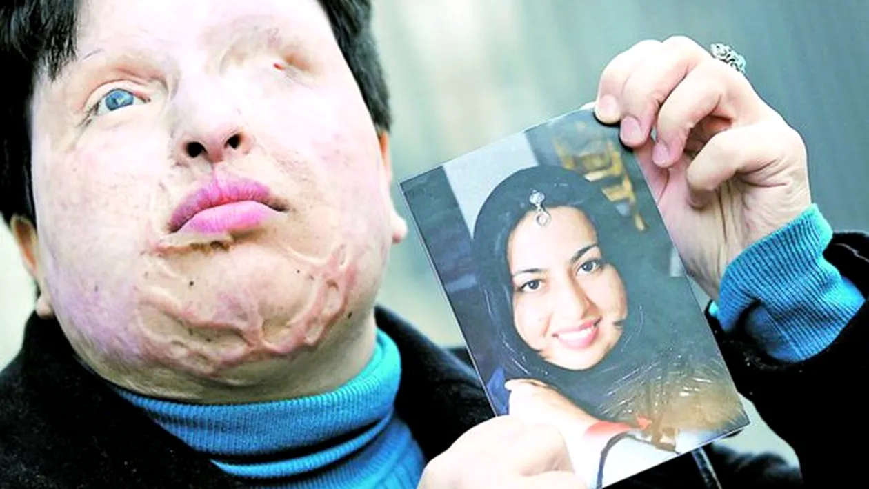 O iranianca desfigurata a primit dreptul sa se razbune! Ii va picura acid in ochi atacatorului