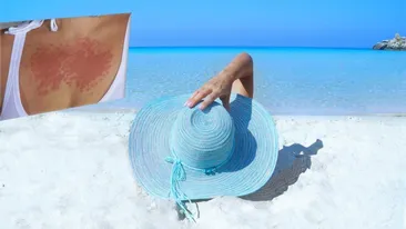 Alergia la soare – simptome și tratament