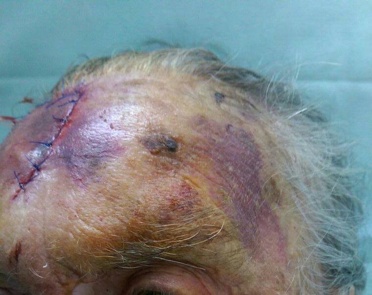 IMAGINI HORROR! Bătrână de 95 de ani, desfigurată cu bâta pentru banii de pensie! Reacţia medicului: ”N-a mai apucat, că…”