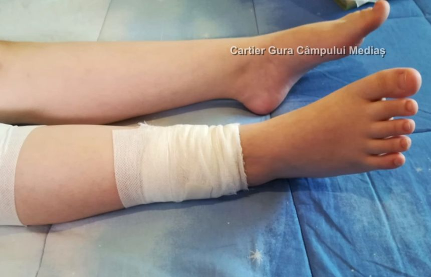 Fetiță de 10 ani din Mediaş, atacată de un câine maidanez. Copilul a fost mușcat de nas, mâini și picioare | VIDEO
