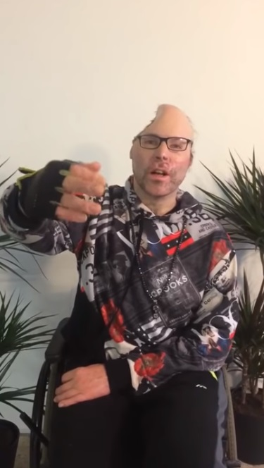 Rapper-ul Dr Knarf, paralizat și mutilat și pe viață. Primele imagini după ce medicii i-au îndepărtat jumătate din cap în urma exploziei produsă la un laborator de droguri