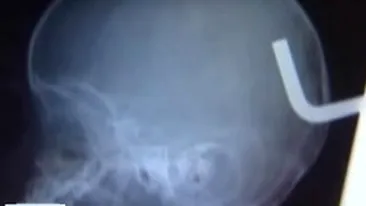 VIDEO Un bebelus a scapat cu viata, dupa ce i-a intrat in cap o tija metalica de sapte centimetri