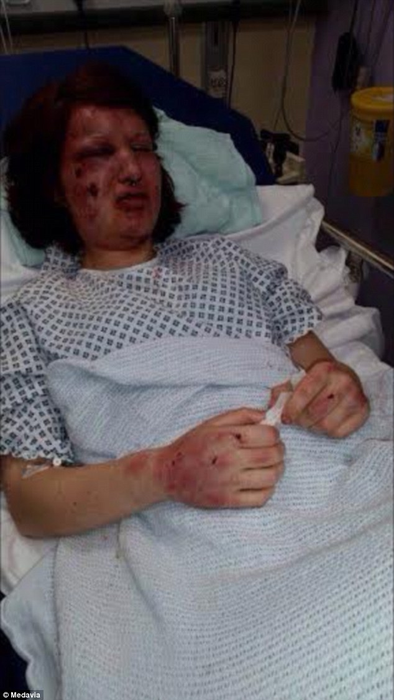 O femeie de 25 ani, traumatizată pe viaţă după fostul ei iubit a muşcat-o pe faţă de 21 de ori! „A încercat să mă mănânce”