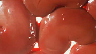 Rinichii romanilor saraci, transplantati ilegal intr-o clinica din Africa de Sud