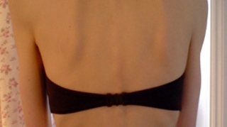 Uite in ce hal arata o adolescenta anorexica! Are 30 de kilograme si mananca doar bomboane fara zahar