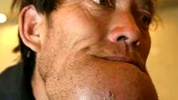 INGROZITOR! Unui chinez ii poate exploda barbia oricand! I s-a umflat incredibil de mult!