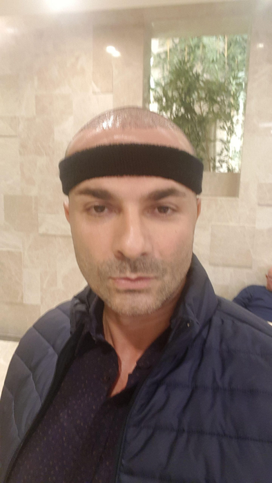 Ești interesat de procedura de implant de păr? Consilierul medical Ensar Duman îți spune ce tehnici noi se realizează în Turcia