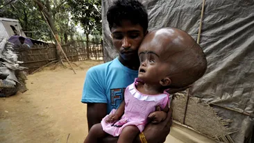 Minune in lumea medicală! Fetiţa care s-a născut cu cap de extraterestru a fost operată! Uite cum arată acum micuţa