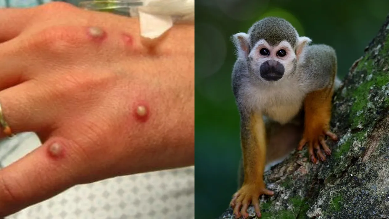 Organizaţia Mondială a Sănătăţii a convocat comitetul de urgenţă! Variolei maimuţei devine un pericol real