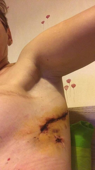 Imaginile şocante cu femeia bolnavă de cancer care a făcut apel la Ministrul Sănătăţii