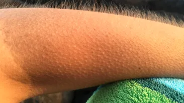 De ce ni se face pielea de găină? Ce este, de fapt, ”fenomenul”