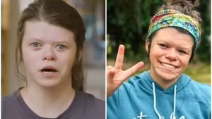 Tânăra din imagine suferă de o afecțiune extrem de rară, se îndrăgostește de oricine! Ce este sindromul Williams și cum se manifestă 