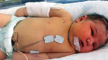 I-au rupt mana ca sa o poata aduce pe lume! Cum arata fetita care era sa moara pentru ca era prea dolofana