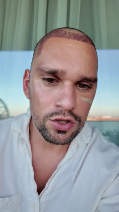 Vlad Gherman, după implantul de păr/ Sursa foto: Instagram