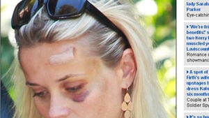 Uite cum arata Reese Witherspoon dupa ce a fost lovita de masina!