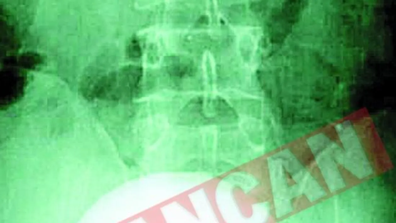 A avut o piatra la rinichi de peste un kilogram