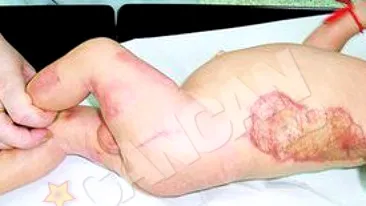 Parintii copilului ars in incubator ar putea primi 450.000 de euro!