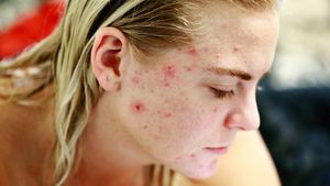 Copilul tău adolescent suferă de acnee? Ajută-l să-i dea CANCEL cu ajutorul medicilor dermatologi