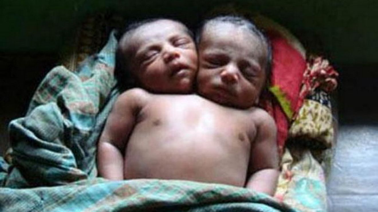 Caz uluitor, in India! O femeie a nascut un copil cu doua capete! Uite imaginile cu bebelusul!