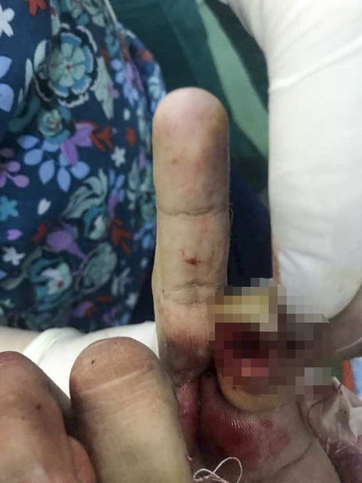 Bebino a ajuns pe masa de operație, cu răni grave
