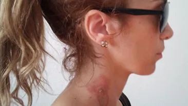 Annes a fost arsa pe gat cu ondulatorul de catre hair stylista! Cantareata se trateaza acum cu sange de vitel!