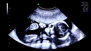 Doctorii au fost ingroziti cand l-au vazut pe acest bebelus: avea 4 maini si 4 picioare! A fost operat la 9 zile dupa nastere